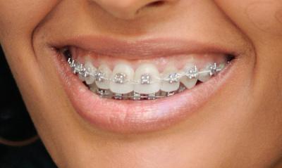 Syst mes multi attaches Centre d orthodontie Lille Wazemmes